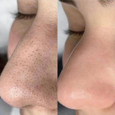 Higiene facial Resultado de higiene facial en centro de Palma