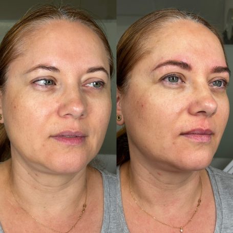 Antes y despúes Antes y despúes